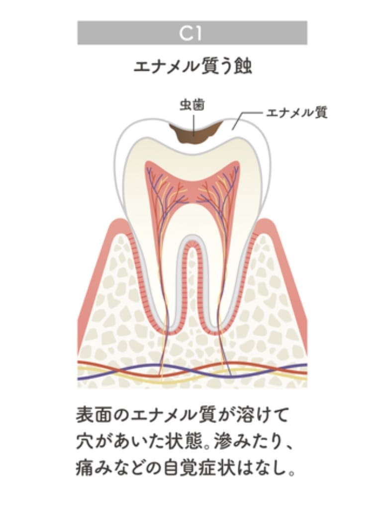 初期虫歯C1の画像