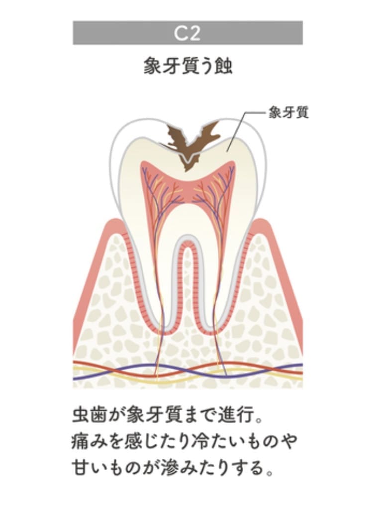 中等度虫歯C2の画像