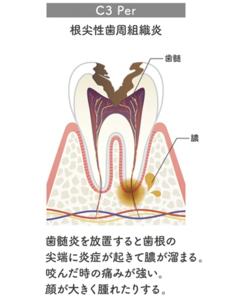 重症の虫歯C3の画像
