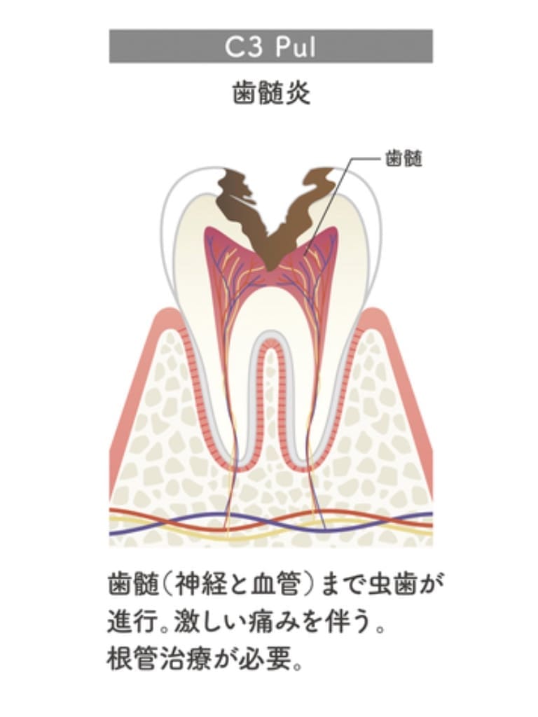 重症の虫歯C3Pulの画像