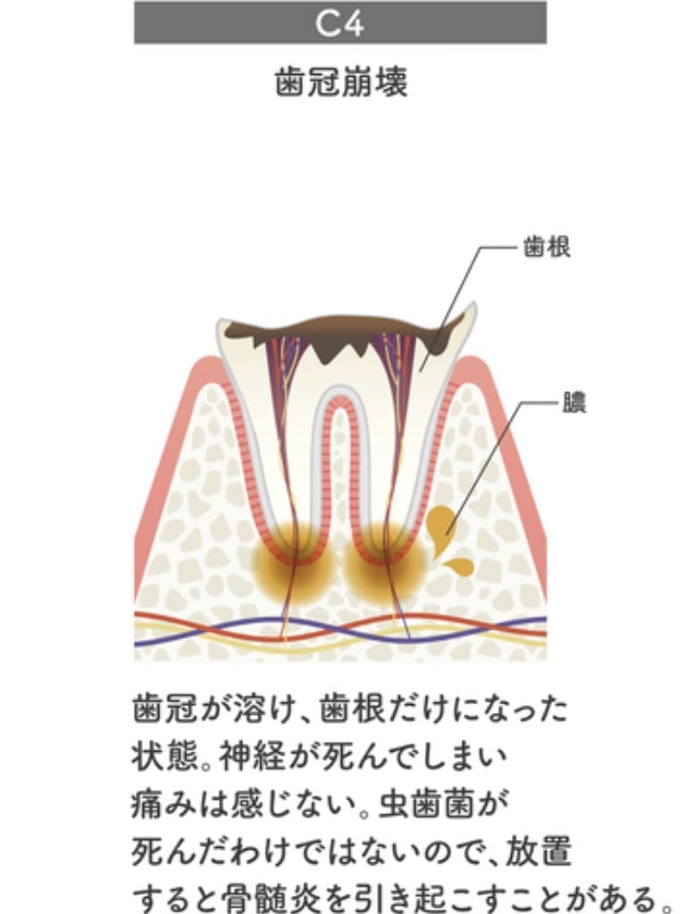 重症かつ末期の虫歯C4の画像