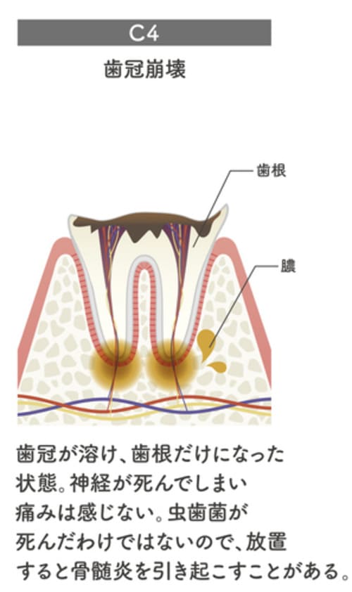 手遅れの虫歯の画像