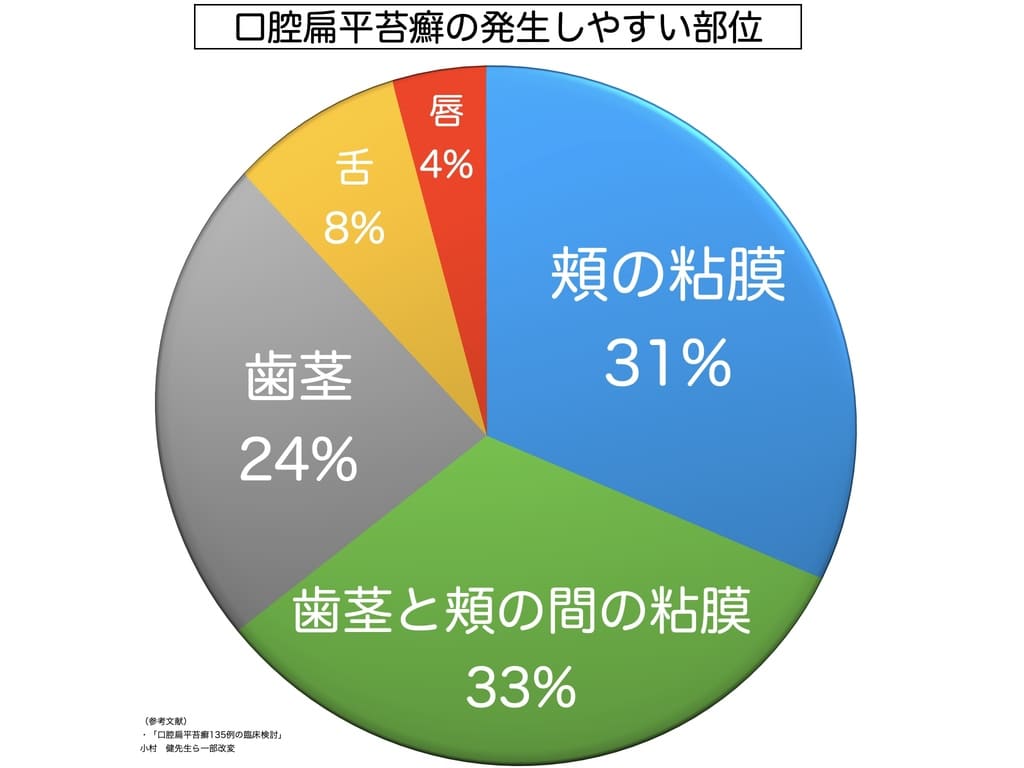 口腔扁平苔癬の好発部位を示すグラフ画像