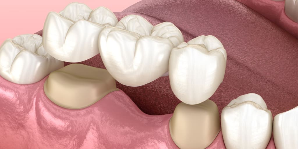 歯のブリッジ治療の画像