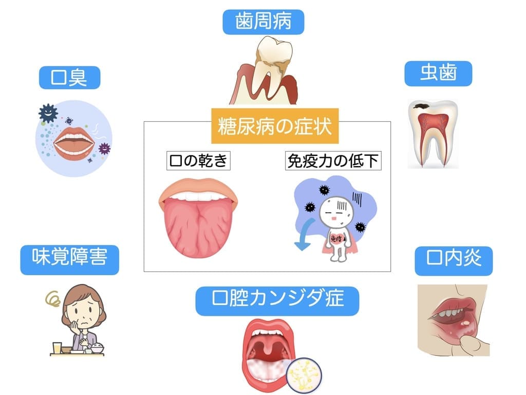 糖尿病と関連する口腔疾患の画像
