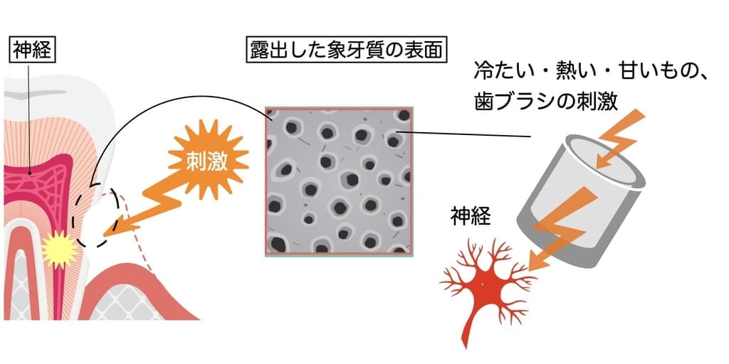 知覚過敏の仕組みを示す画像