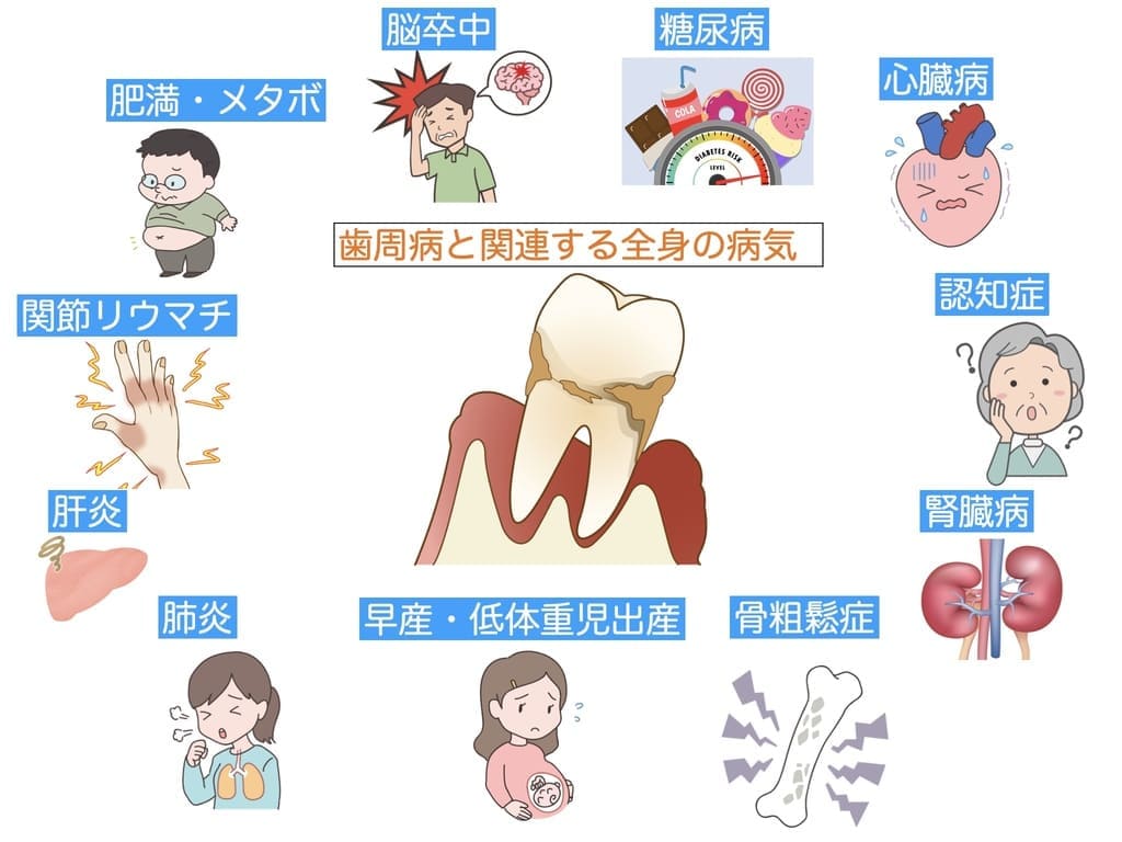 歯周病と関連する全身疾患の画像