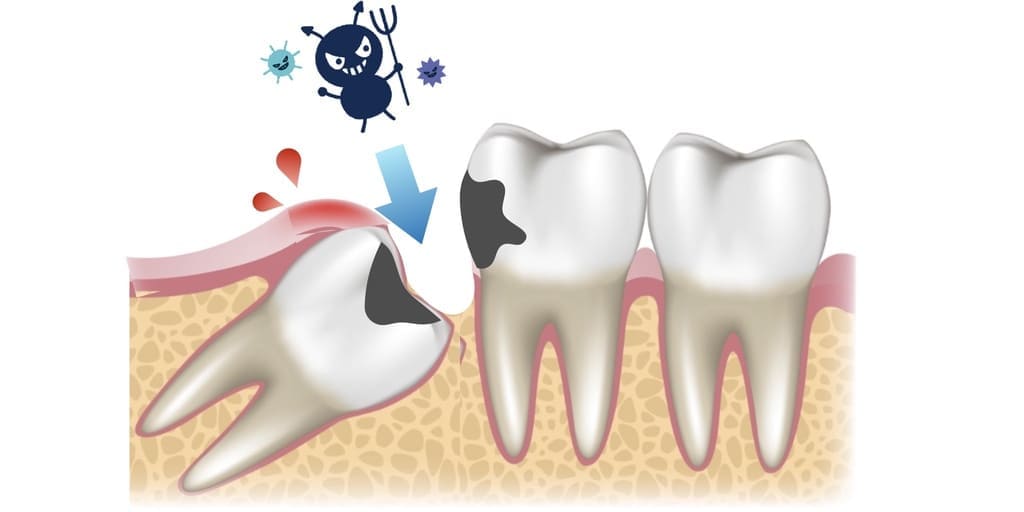 親知らずの虫歯、歯茎の腫れの画像
