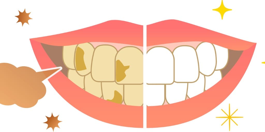 歯の着色と口臭の画像