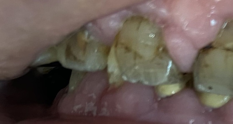 薬物性歯肉増殖症の画像