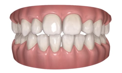 歯並びの3Dシミュレーション画像