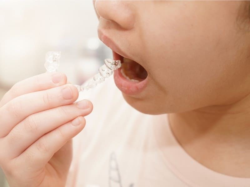 マウスピースを装着する子供の画像