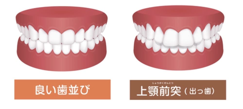 出っ歯の画像