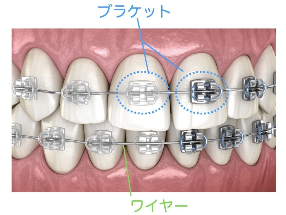 ワイヤー矯正の部品の解説画像