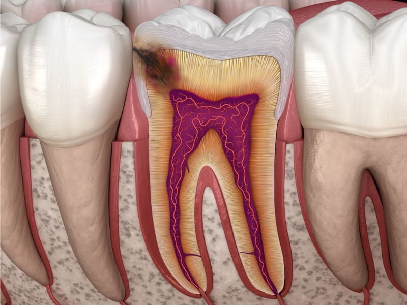 歯の神経に達する虫歯の画像