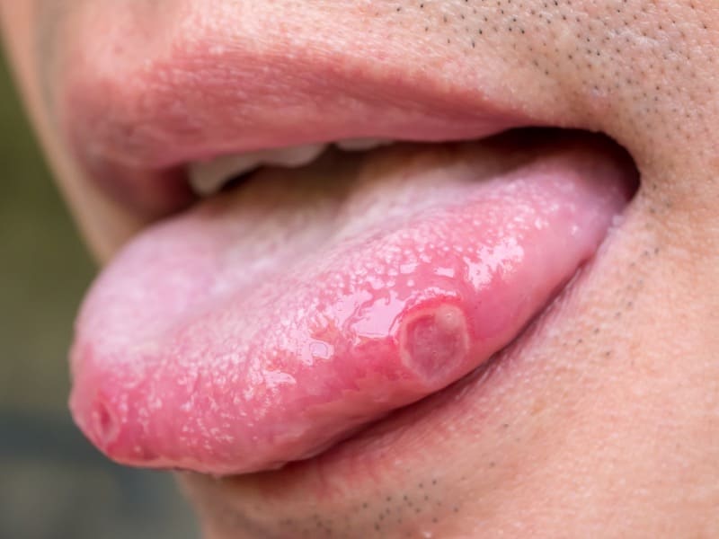 舌の口内炎の画像