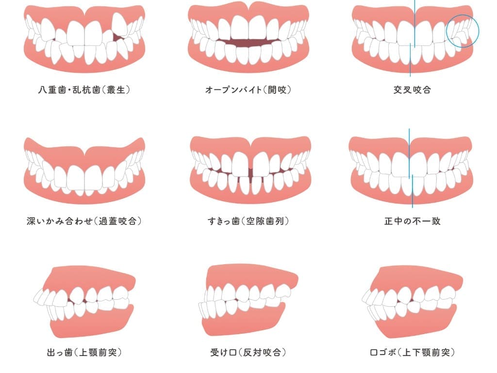 歯並びの種類を示す画像