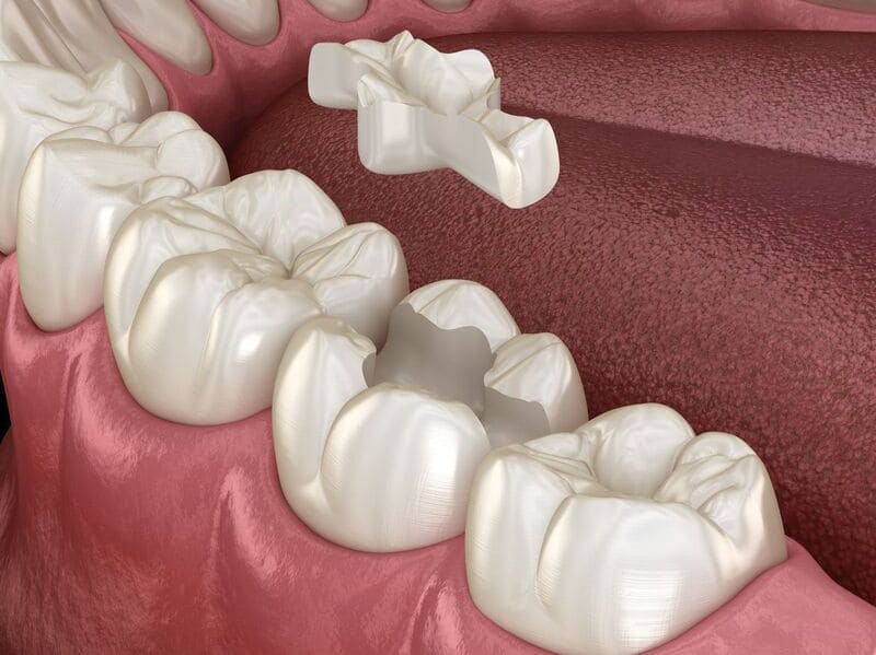 歯のセラミックの画像