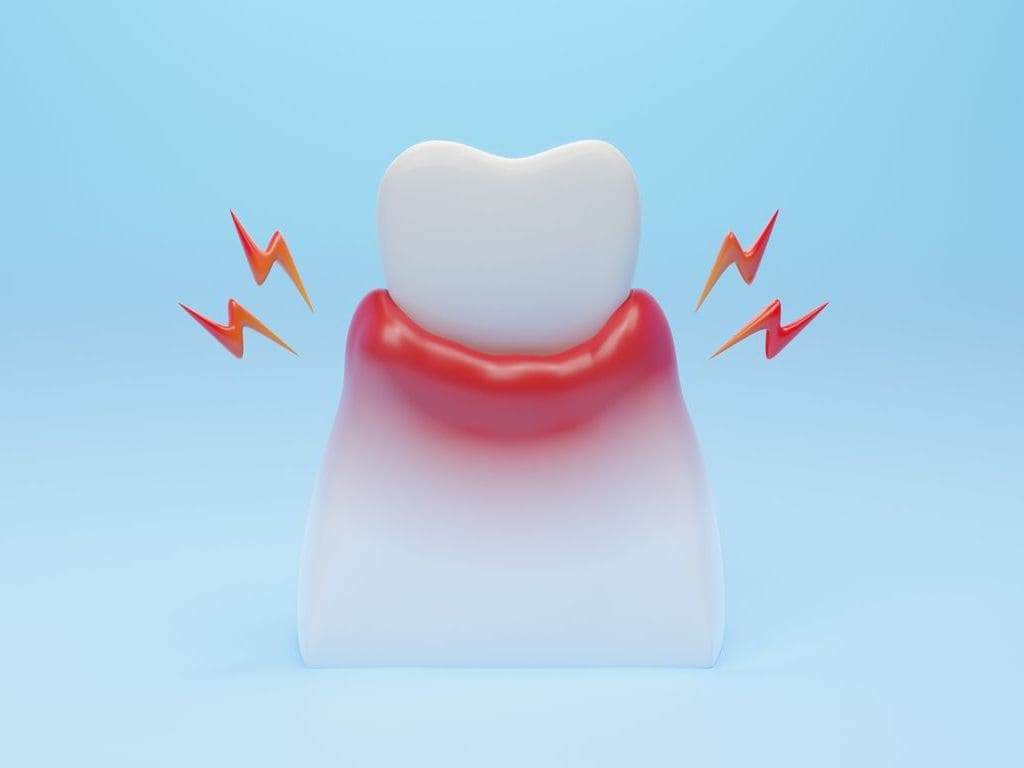 歯茎の腫れの画像