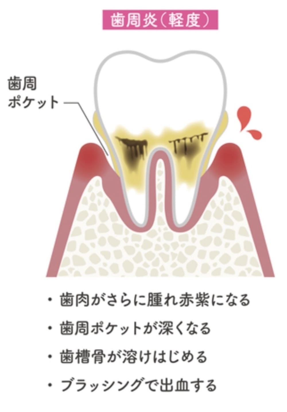 軽度の歯周病の解説画像