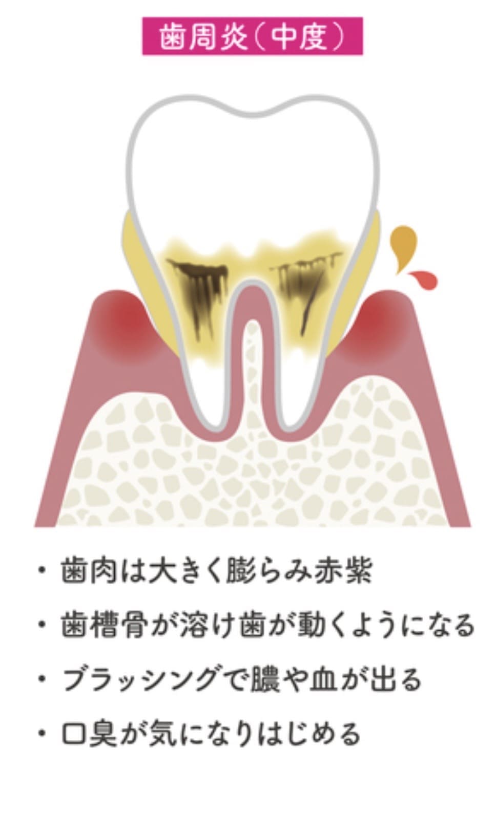 中等度の歯周病の解説画像