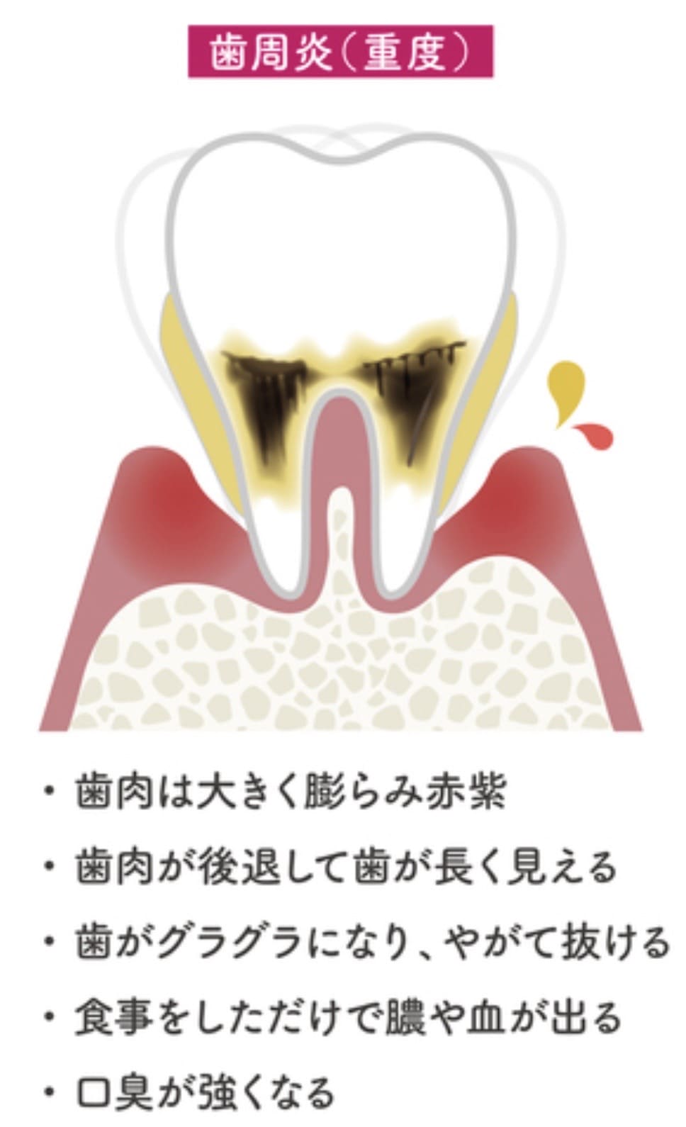 重度の歯周病の解説画像