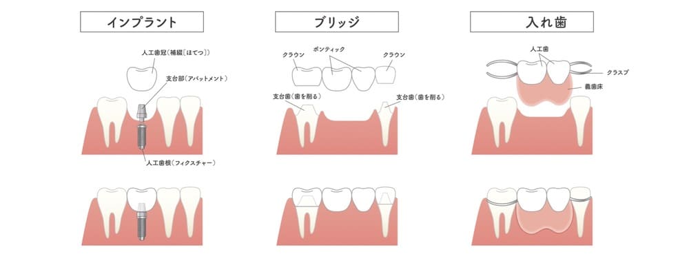 インプラント、ブリッジ、入れ歯の画像