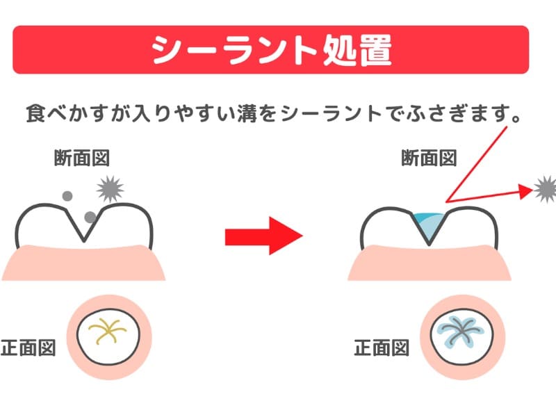 シーラント処置の説明画像