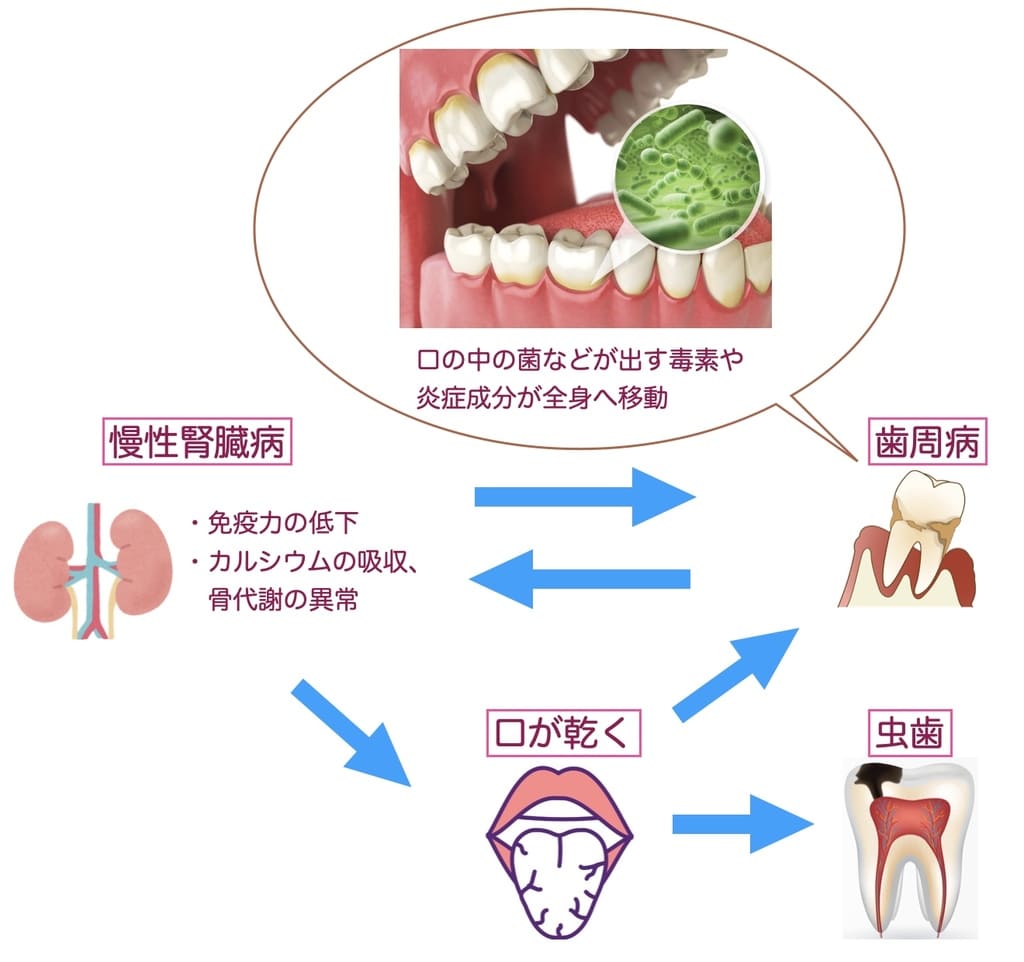 腎臓病と歯周病・虫歯の関係性を示すイラスト画像